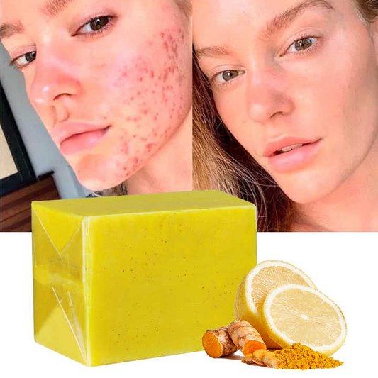 Best Turmeric Soap for Acne – Top 5 Picks in 2025